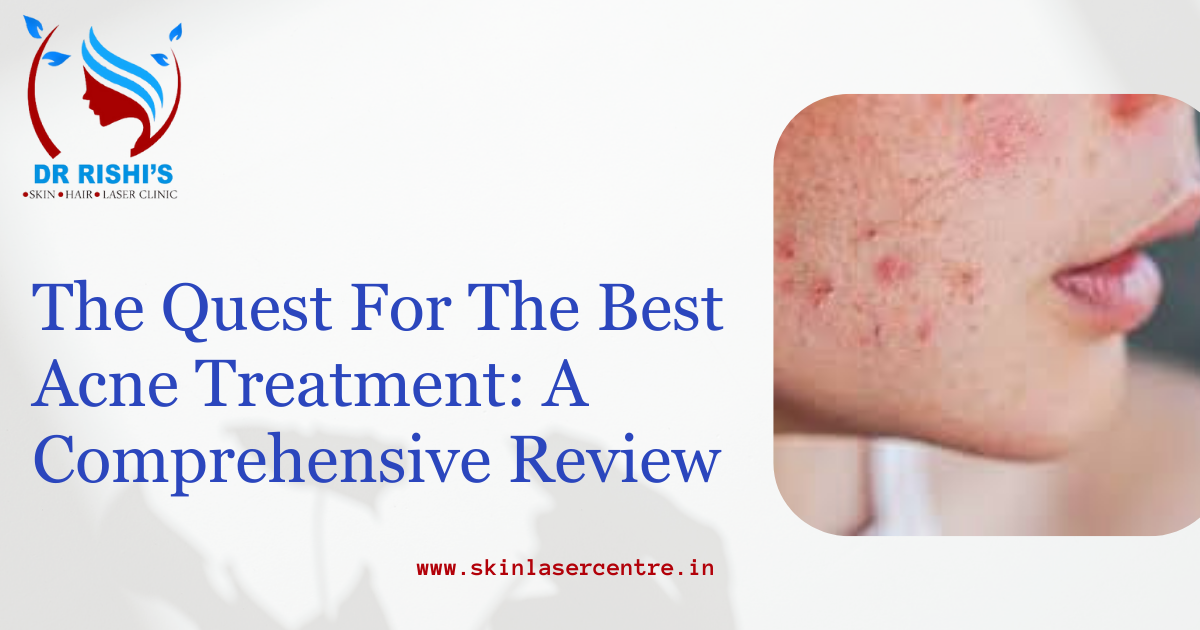 The Quest For The Best Acne Treatment: A Comprehensive Review